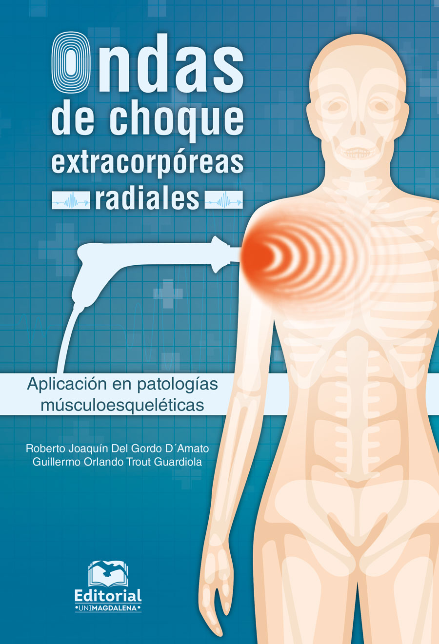 ONDAS DE CHOQUE EXTRACORPÓREAS RADIALES